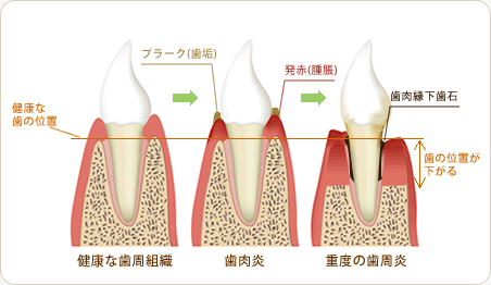 健康な歯周組織　歯肉炎　重度の歯周炎