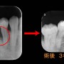 歯周病と再生療法①